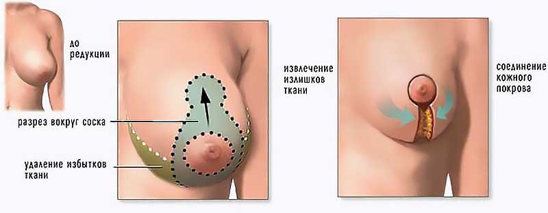 Увеличение груди (Аугментация)